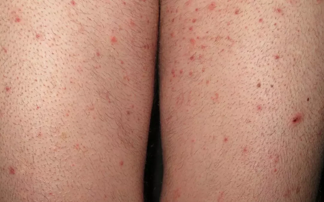 Aparecen nuevos brotes de sarna por toda España