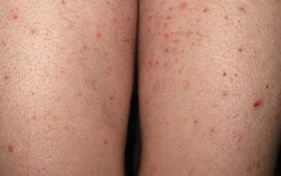Aparecen nuevos brotes de sarna por toda España